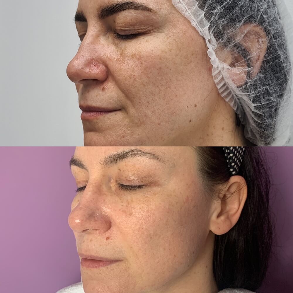 Zabieg radiofrekwencji mikroigłowej - porównanie przed i po